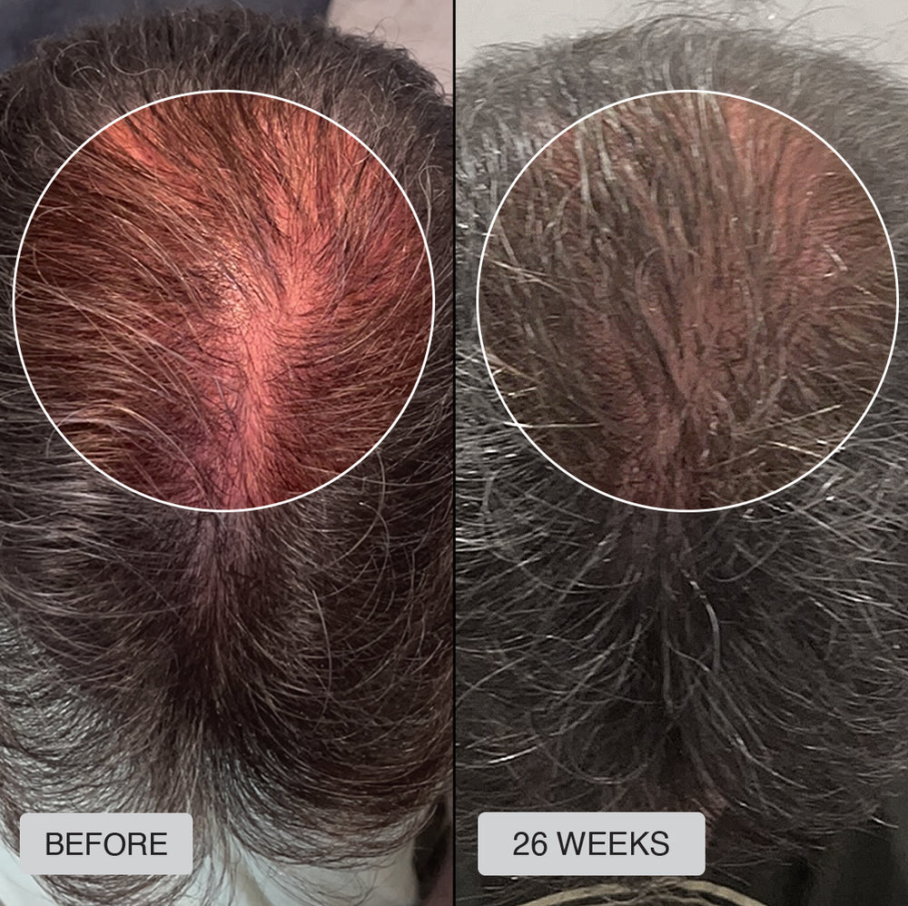 FDA Approved HairRevive Red Light Therapy Hat - LumiGrowth