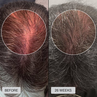 FDA Approved HairRevive Red Light Therapy Hat - LumiGrowth