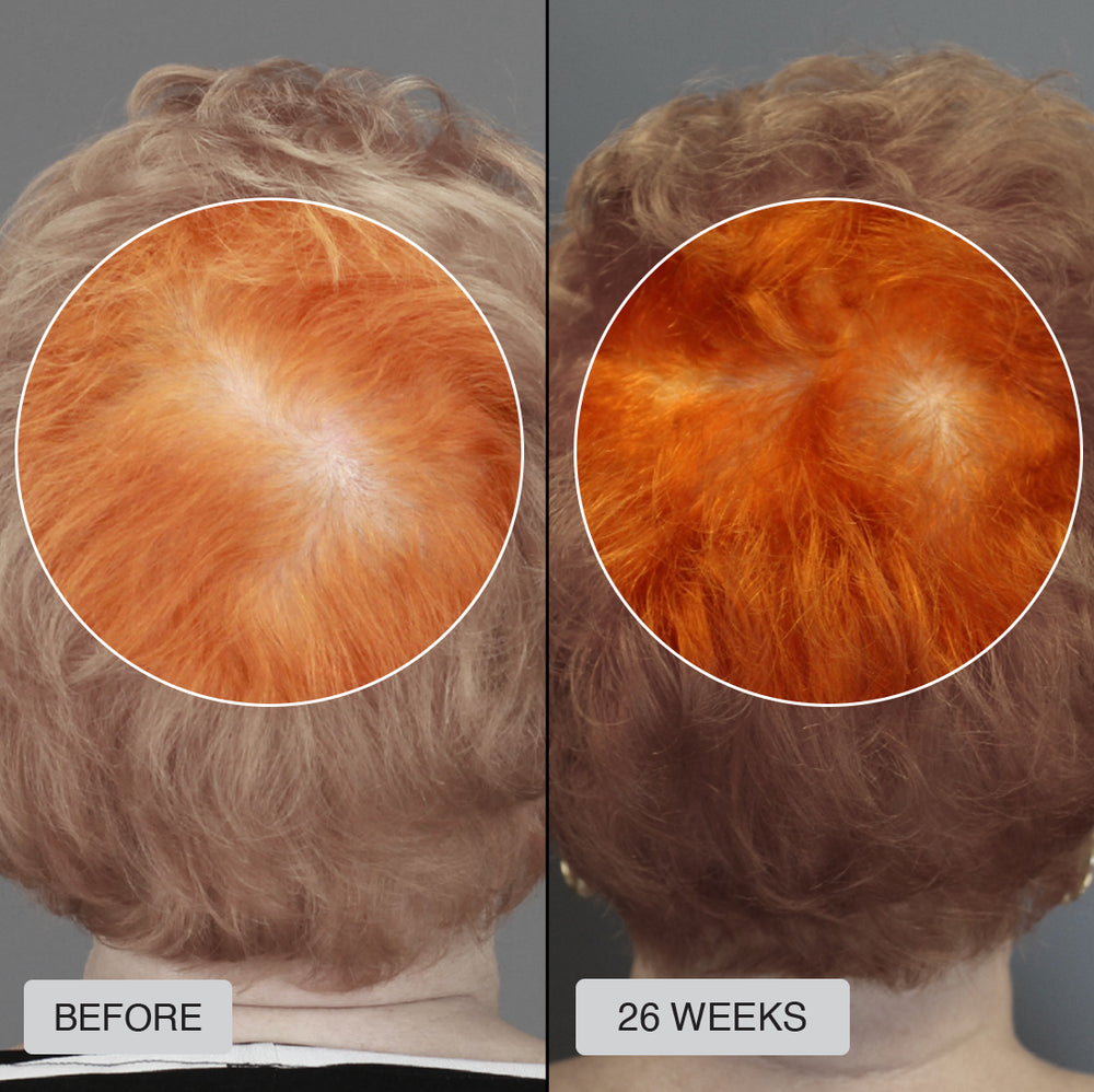 FDA Approved HairRevive Red Light Therapy Hat - LumiGrowth