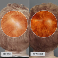 FDA Approved HairRevive Red Light Therapy Hat - LumiGrowth