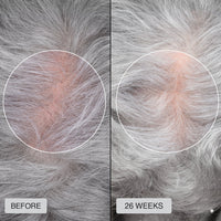 FDA Approved HairRevive Red Light Therapy Hat - LumiGrowth